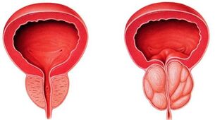 Inflammation of the prostate