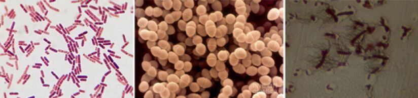 E. coli, fecal enterococcus, and proteus are major causes of chronic bacterial prostatitis