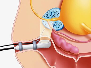 Pricked biopsy of the prostate