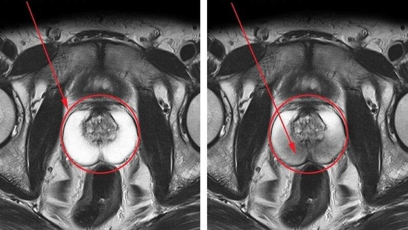 healthy and inflamed prostate with chronic prostatitis