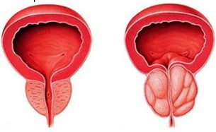 the prostate gland